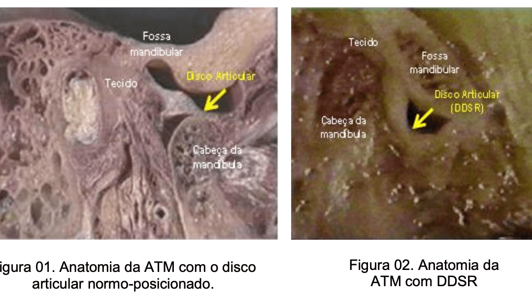 Tese de Doutorado – Avaliação da efetividade do tratamento da articulação temporomandibular (ATM) com deslocamento do disco sem redução (DDSR)