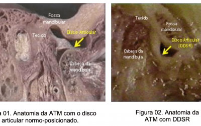 Tese de Doutorado – Avaliação da efetividade do tratamento da articulação temporomandibular (ATM) com deslocamento do disco sem redução (DDSR)
